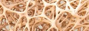 Osteoporosi: cos’è, cause, sintomi e cura